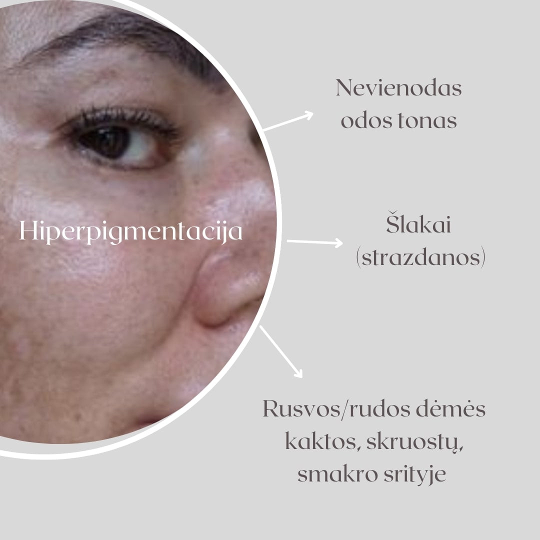 kaip kovoti su odos hiperpigmentacija pigmentines demes