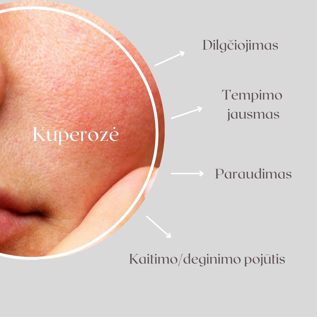 kuperozines odos prieziura kaip kovoti su odos raudoniu rozacea labai jautri oda